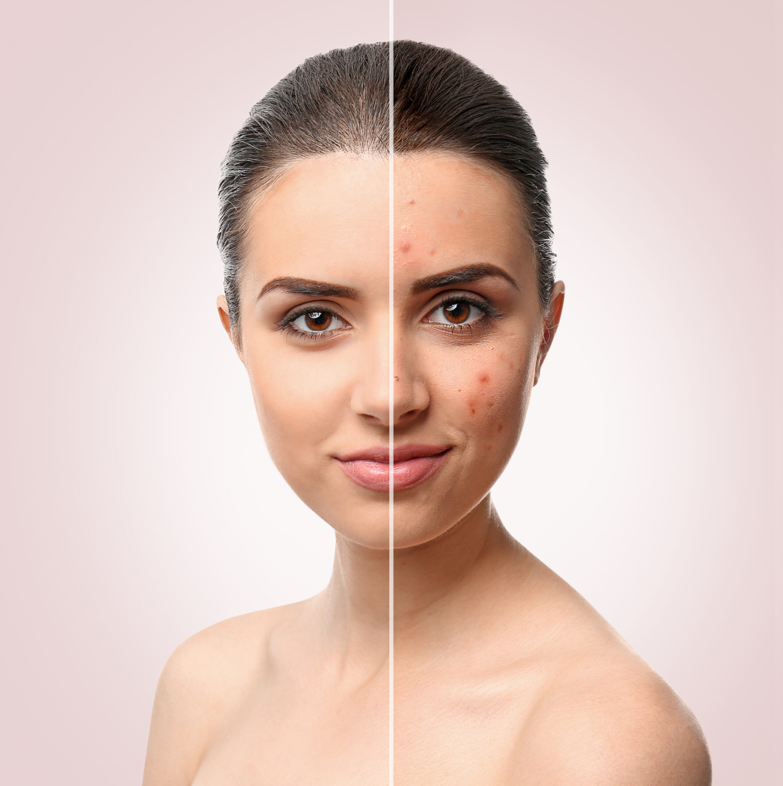 Woman face before and after acne treatment procedure. Skin care